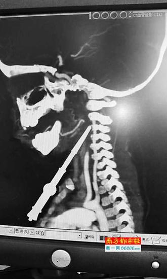 影像显示，塔尖直接进入第二、第三节颈椎之间，有5-6厘米深。受访者供图